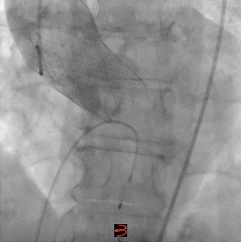 Figure 4. Final aortogram after implantation of the Portico THV.