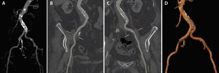 Figure 1.  Contrast CT image of the iliofemoral arteries (A), snake view of the right iliac (B), snake view of left Iliac (C), and three-dimensionally rendered image of the iliofemoral arteries (D).