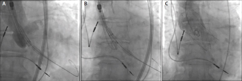 Figure 2.  FlexNav delivery system across the aortic valve (A). Initial stages of Portico valve deployment (B). The Portico valve in position (C).
