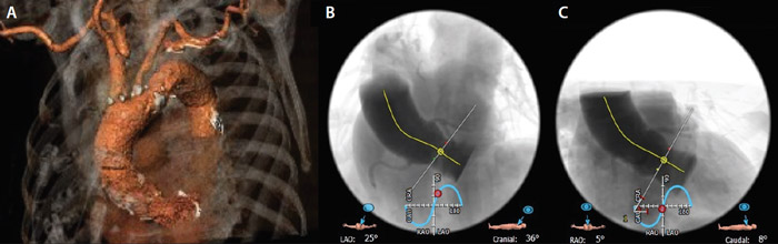 Figure 1.  Preprocedural CT scan: three-dimensional rendering of aortic arch (A), left cranial (B), and right caudal (C) projections showing a 58° horizontal aorta.