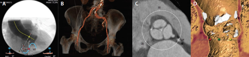Figure 2.  Preprocedural CT scan showing a 58° aortic angle (A), mild degree of tortuosity with moderate aortic bifurcation calcification (B), and a tricuspid aortic valve with moderate annular calcification (C, D).