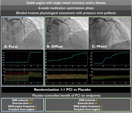 Stable angina with signle vessel coronary artery disease