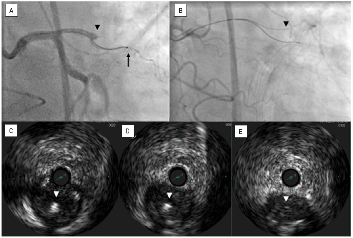 Chronic total occlusions