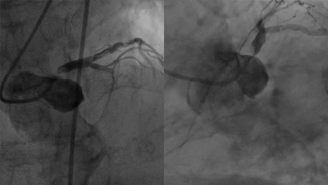 NSTEMI case due to a severe LM calcific sub-occlusive stenosis