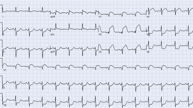 Rotational atherectomy in anterior STEMI 