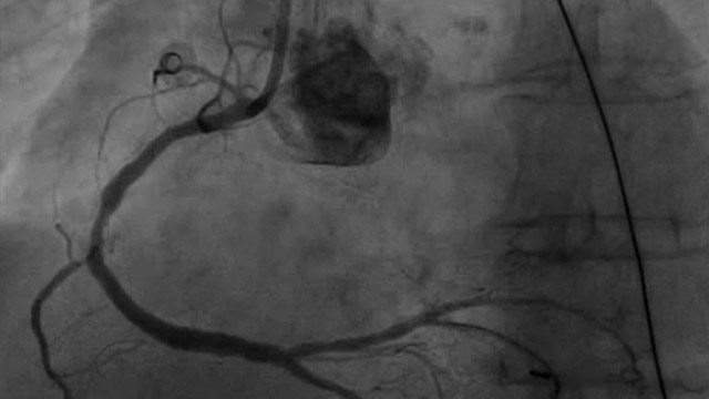 Strategy for calcified CAD in a patient with MVD