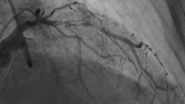 A “perfect” case for rotational atherectomy…