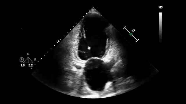 Die Hard: high-risk PCI in calcified LM and severe LV dysfunction