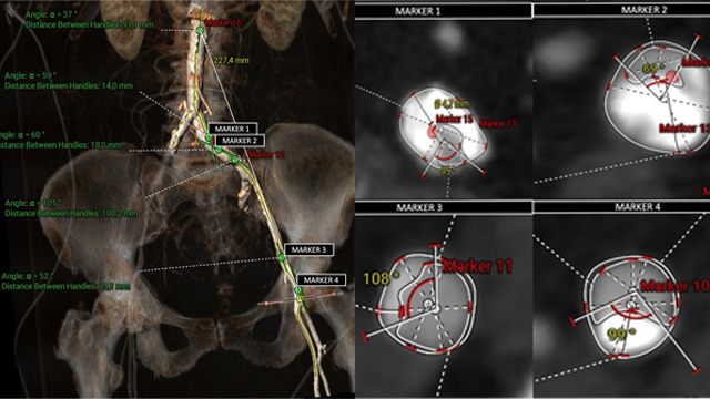 Hostile iliac access managed with IVL - How far can we go?