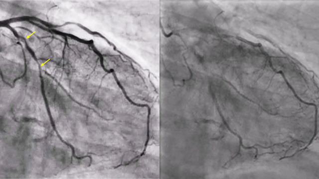 Treating an “uncrossable” lesion