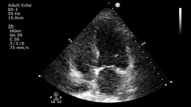 How to manage complex calcified coronary disease in severe LV failure