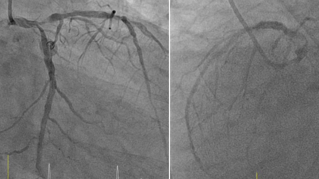 Complex distal left main bifurcation lesion