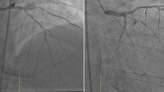 LAD/D1 bifurcation disease
