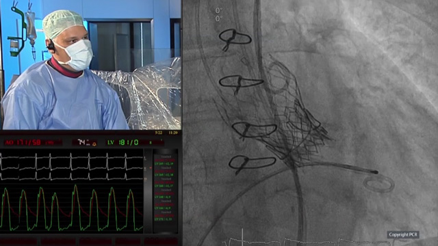 TAVI for aortic valve-in-valve