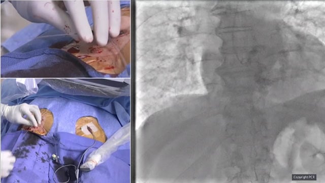 TAVI in a bicuspid aortic valve stenosis