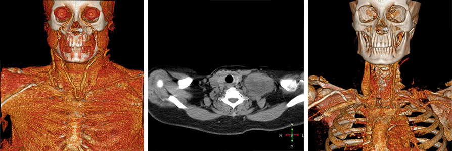 An iatrogenic aneurysm managed in cathlab