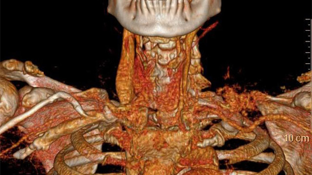 An iatrogenic aneurysm managed in cathlab