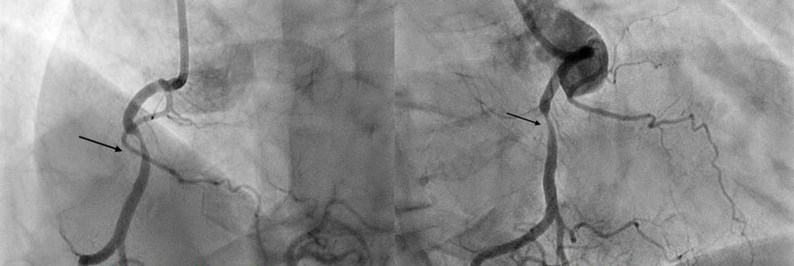 How should I treat an RCA lesion with ambiguous physiology by FFR, iFR and CFR?