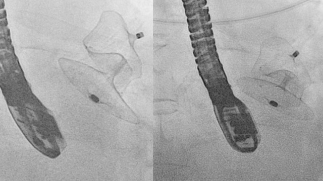 Pulling the plug: Retrieving a partially dislodged atrial appendage occlusion device without a snare