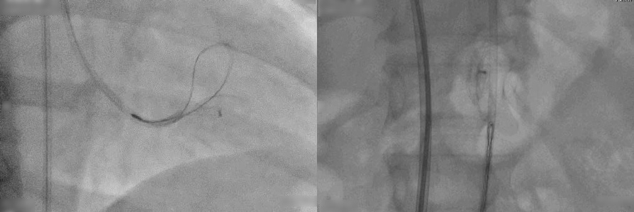 Retrieval of embolised atrial septal occluder device with urology forceps