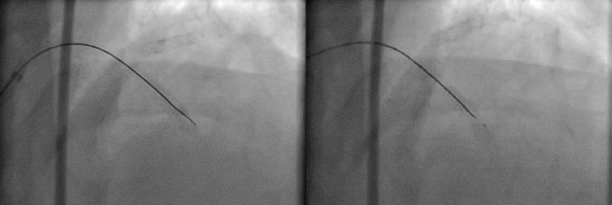 Spring coil fracture of coated double core hard wire during CTO Angioplasty