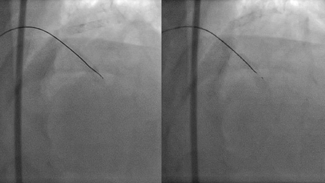 Spring coil fracture of coated double core hard wire during CTO Angioplasty
