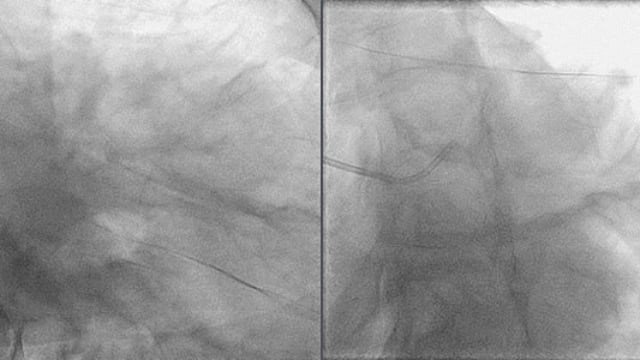 Successfully treated type F dissection while rewiring main vessel during Culotte technique in complex bifurcation stenosis