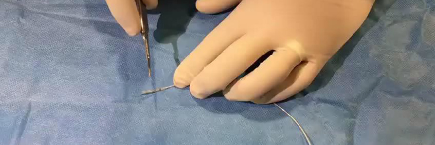A novel technique to seal distal coronary perforations