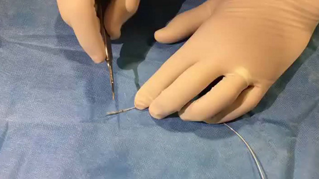 A novel technique to seal distal coronary perforations