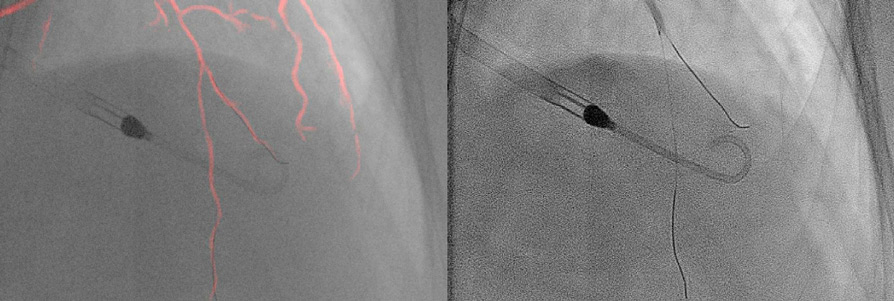 Imaging and physiology-guided PCI without contrast administration in advanced renal failure