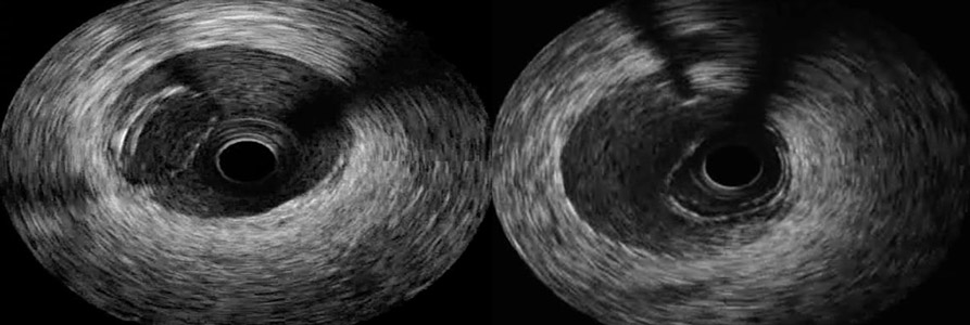 Right coronary intramural hematoma