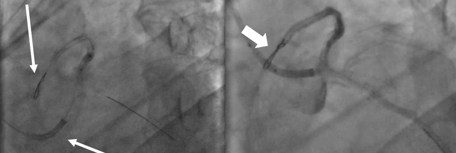 Stent disruption and knotted wire - how to resolve?