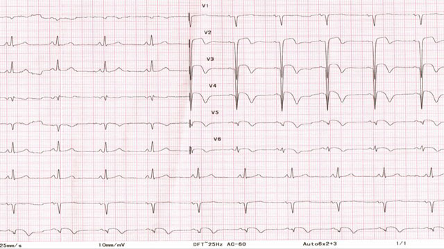 CISPLATIN induced coronary artery thrombosis presented as ACS