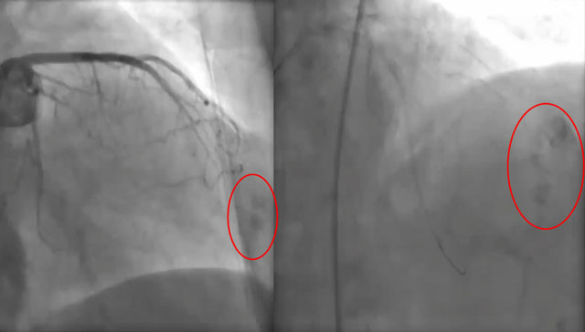 To treat distal coronary perforation