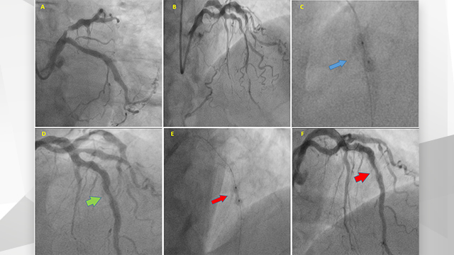 How should I Treat underexpanded coronary stents due to severe coronary calcification?