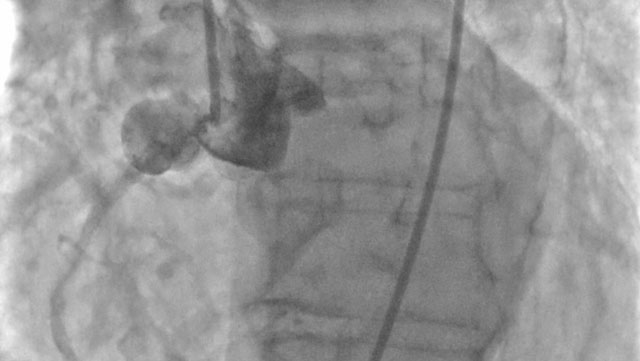 Unusual, late presentation of coronary pseudoaneurysm due to stent fracture