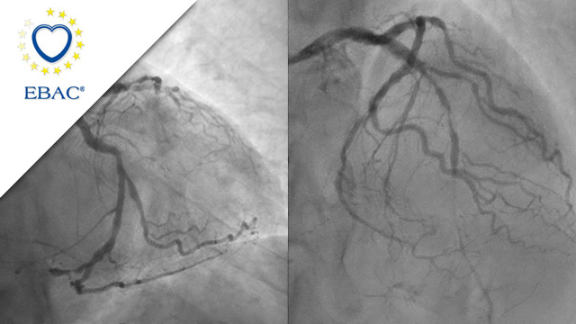 How should I treat? - An innovative approach to treat diffuse disease