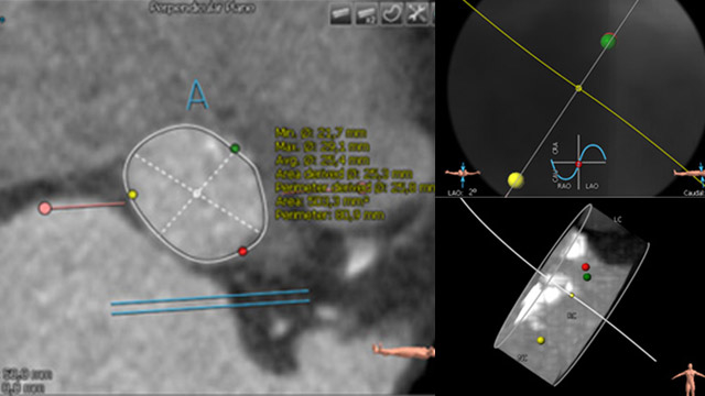 How should I treat? - How to reduce cardiac conduction disturbance with Sapien 3 valve?