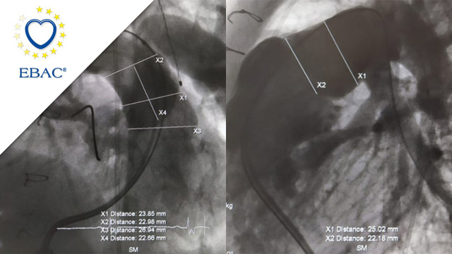 Native RVOT valve implantation - When small is not too small, when young is not too young and when real life is less 'stiff' than percutaneous tools!