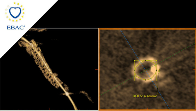 3DStent: a new tool to evaluate stent expansion besides intra-coronary imaging