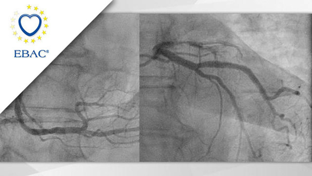 Concomitant aortic valve stenosis and coronary disease in young population with low risk. The younger, the better? 