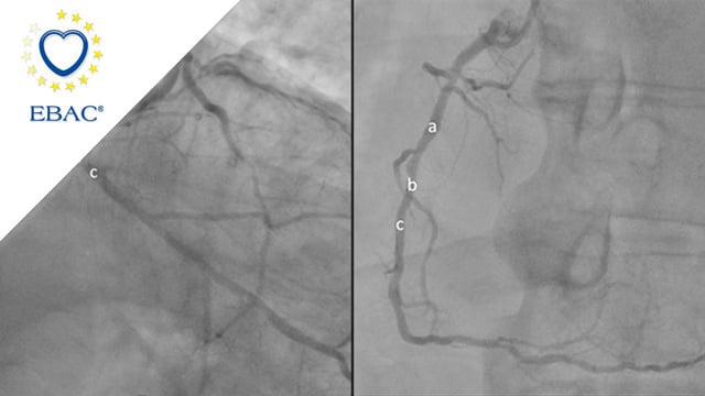 How should I treat a left main disease with multivessel diffuse CAD? Stenting only the necessary