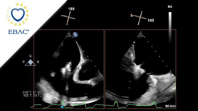 How should I treat a torrential tricuspid valve regurgitation with large coaptation gap size and severe tethered leaflets?