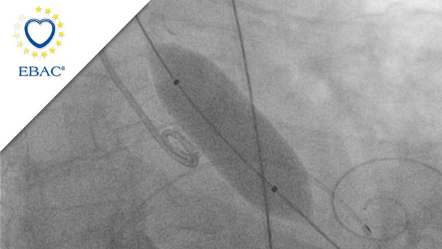 Self-expanding intra-annular TAVI in small annulus