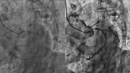 Calcium nodule in circumflex ostium: a complex problem