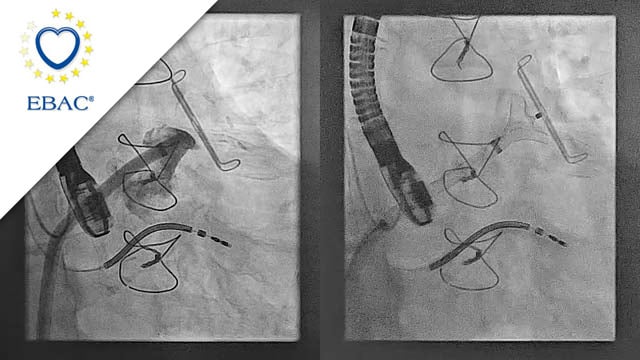 How should I manage a patient with insufficient surgical closure of the left atrial appendage