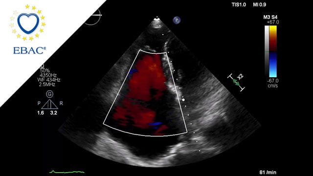 How should I treat a torrential tricuspid valve regurgitation in a young patient who remains symptomatic despite optimal medical therapy?