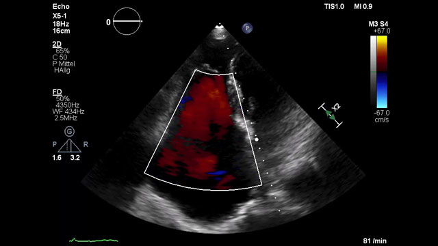 How should I treat a torrential tricuspid valve regurgitation in a young patient who remains symptomatic despite optimal medical therapy?