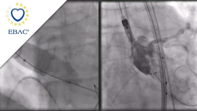 How should I treat this aortic stenosis with small anatomy, low coronary offset and extremely horizontal aorta