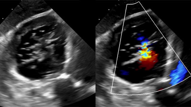 Impact of GDMT on long-term outcome after tricuspid TEER